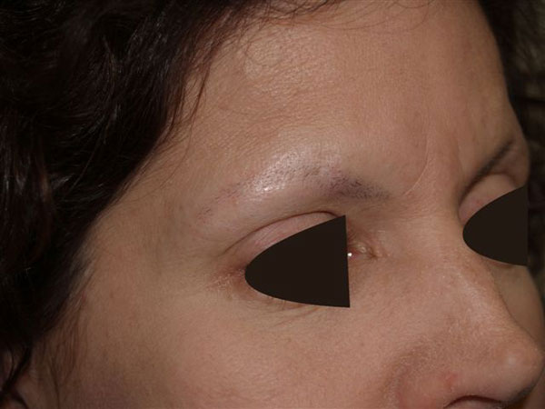 eyebrow transplant - patient 47 - before 2