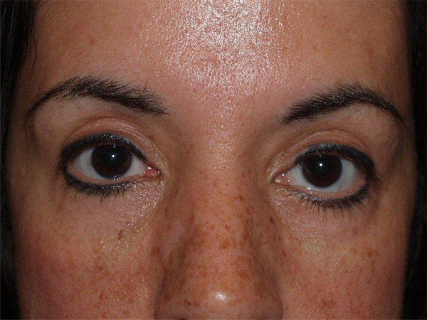 eyebrow and eyelashes - patient 90 - before 1