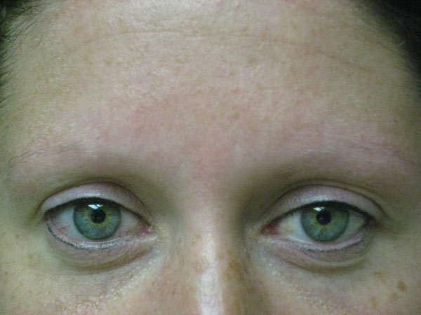 eyebrow and eyelashes - patient 91 - before 1