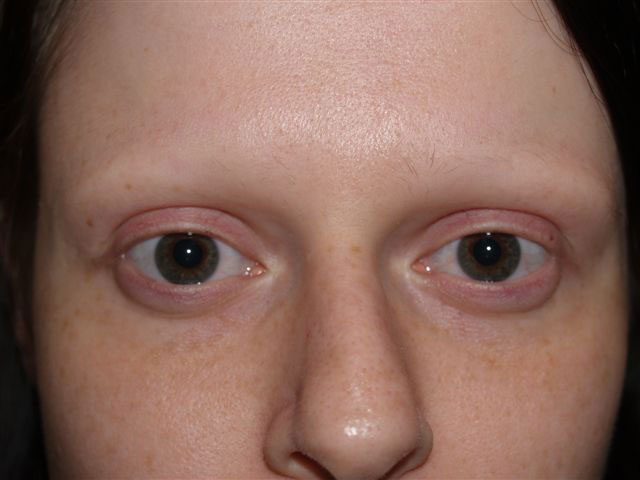 eyebrow transplant - patient 49 - before 1