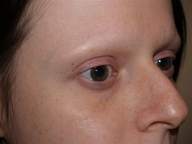 eyebrow transplant - patient 49 - before 2