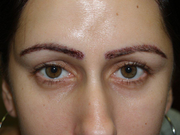 eyebrow and eyelashes - patient 94 - after 1