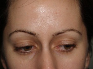 Miami, Fl. Eyebrow and Eyelashes Photo - Patient 1 - Before 1
