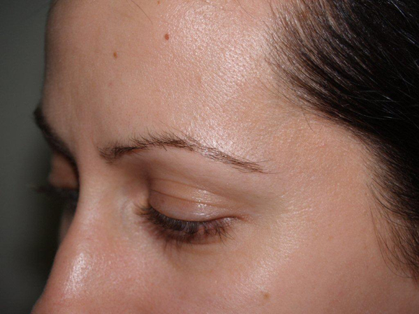 eyebrow and eyelashes - patient 94 - before 3