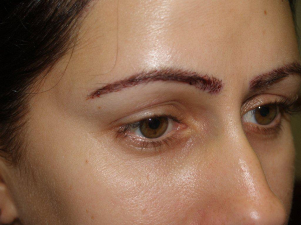 eyebrow and eyelashes - patient 94 - after 2