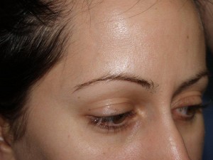 Miami, Fl. Eyebrow and Eyelashes Photo - Patient 1 - Before 2