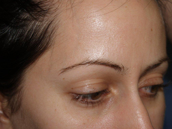 eyebrow and eyelashes - patient 94 - before 2