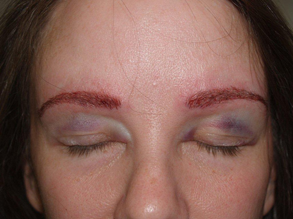 eyebrow and eyelashes - patient 95 - after 1