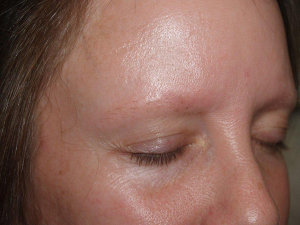 eyebrow and eyelashes - patient 95 - before 2