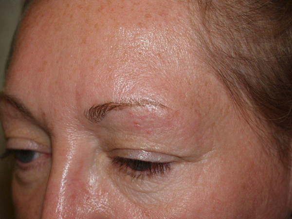 eyebrow and eyelashes - patient 77 - before 2