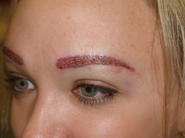 eyebrow and eyelashes - patient 100 - after immediately 2