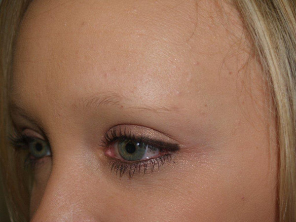 eyebrow and eyelashes - patient 100 - before 2