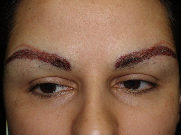 eyebrow and eyelashes - patient 101 - after 1