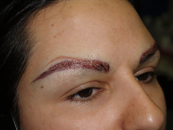 eyebrow and eyelashes - patient 101 - after 2