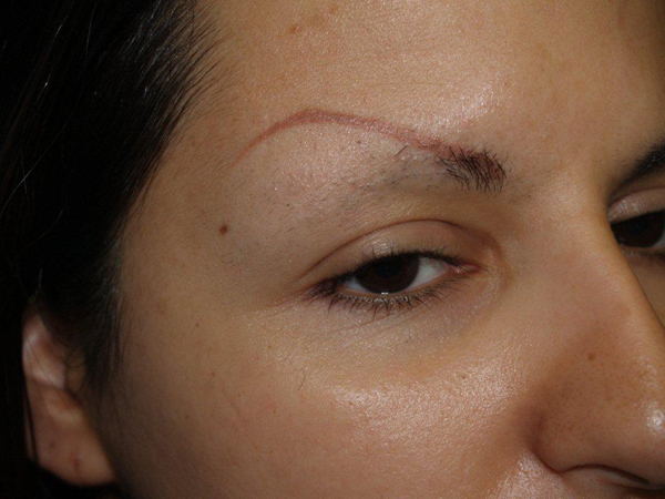 eyebrow and eyelashes - patient 101 - before 2