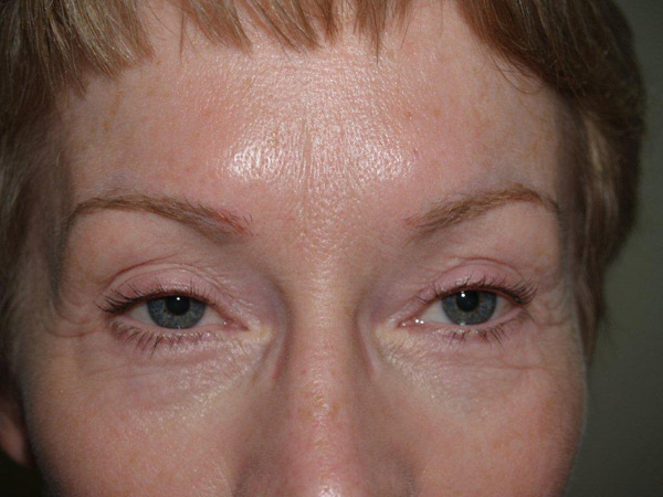 eyebrow and eyelashes - patient 103 - after 1