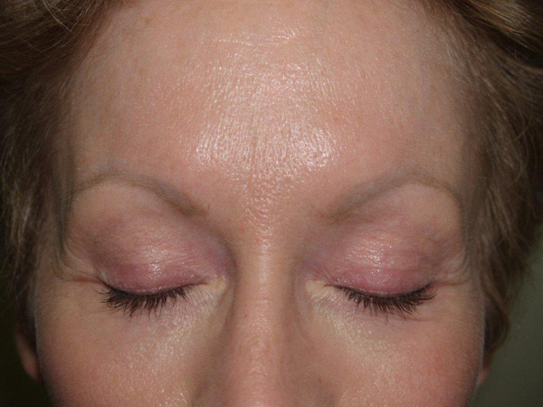 eyebrow and eyelashes - patient 103 - before 1