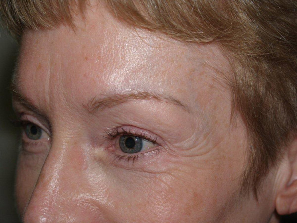 eyebrow and eyelashes - patient 103 - after 3