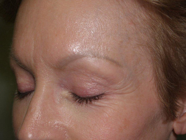 eyebrow and eyelashes - patient 103 - before 3