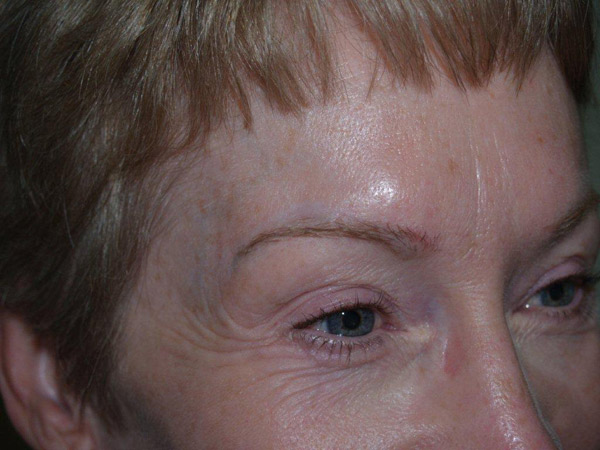 eyebrow and eyelashes - patient 103 - after 2