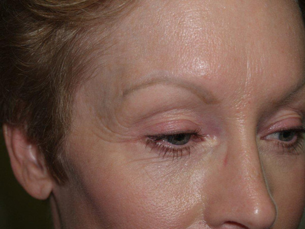 eyebrow and eyelashes - patient 103 - before 2
