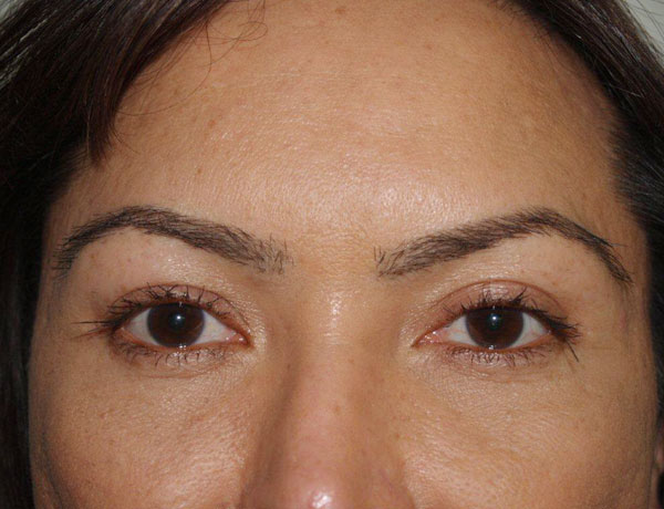 eyebrow and eyelashes - patient 105 - after 1