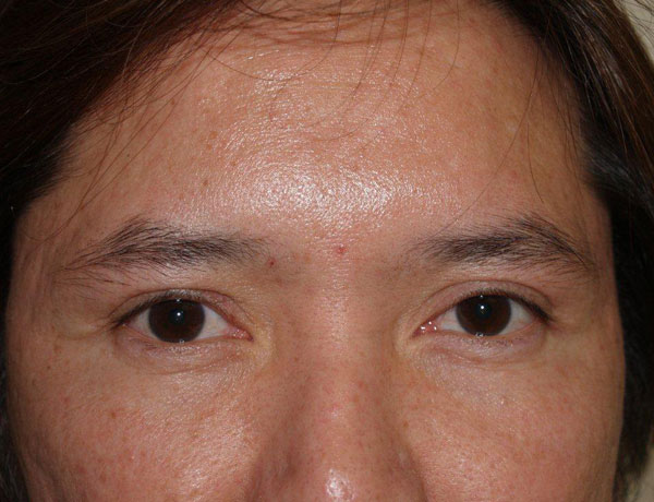 eyebrow and eyelashes - patient 105 - before 1