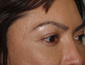 Miami, Fl. Eyebrow and Eyelashes Photo - Patient 1 - After 2
