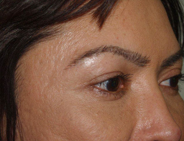 eyebrow and eyelashes - patient 105 - after 2