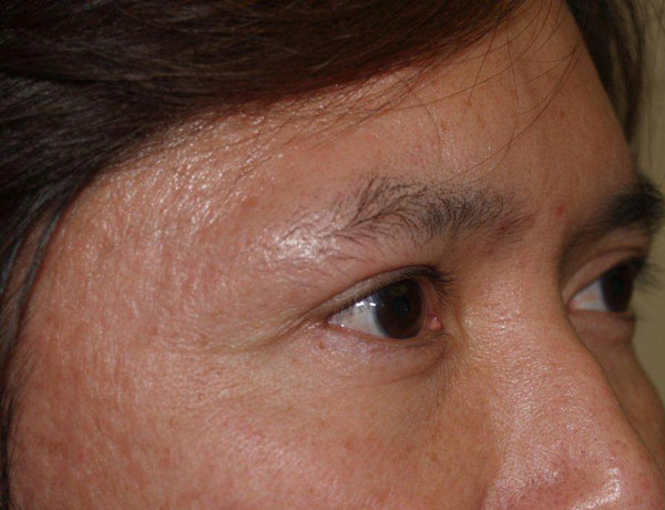 eyebrow and eyelashes - patient 105 - before 2