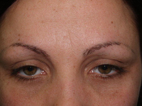 eyebrow and eyelashes - patient 97 - before 1