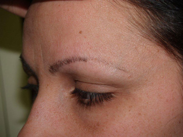 eyebrow and eyelashes - patient 97 - before 3