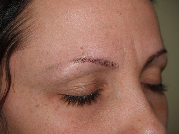 eyebrow and eyelashes - patient 97 - before 2