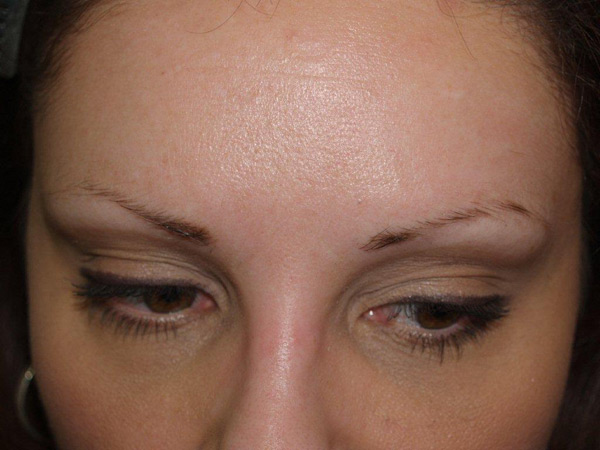 eyebrow and eyelashes - patient 98 - before 1