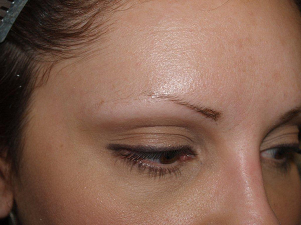 eyebrow and eyelashes - patient 98 - before 2
