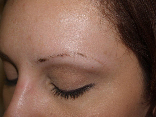eyebrow and eyelashes - patient 98 - before 3