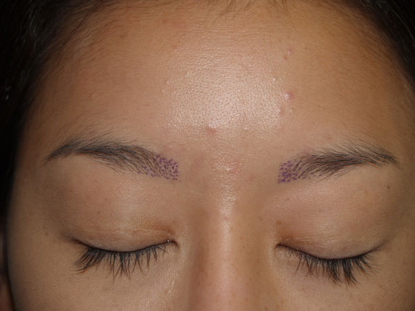 eyebrow and eyelashes - patient 107 - before 1