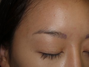 Miami, Fl. Eyebrow and Eyelashes Photo - Patient 1 - Before 2