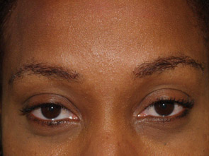 eyebrow transplant - patient 18 - after 1