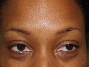 eyebrow transplant - patient 18 - before 1