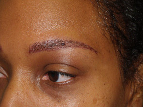 eyebrow transplant - patient 18 - after immediately 3