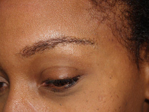 eyebrow transplant - patient 18 - after 3