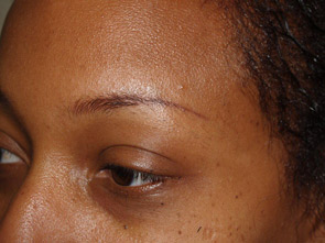 eyebrow transplant - patient 18 - before 3