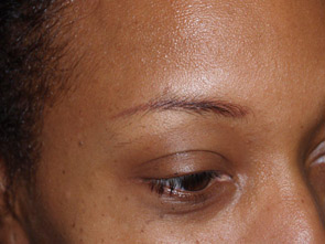 eyebrow transplant - patient 18 - before 2