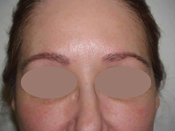 eyebrow transplant - patient 16 - after immediately 1
