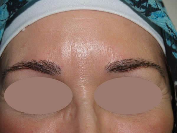 eyebrow transplant - patient 16 - after 1