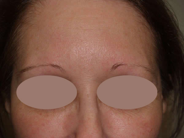 eyebrow transplant - patient 16 - before 1