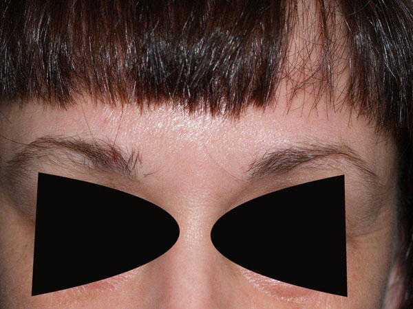 eyebrow transplant - patient 17 - before 1