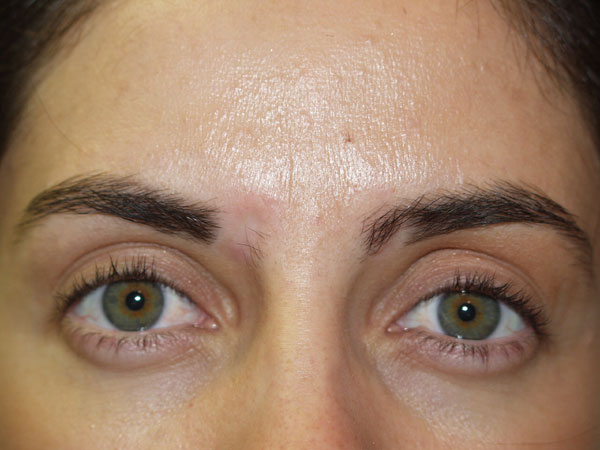 eyebrow transplant - patient 26 - before 1