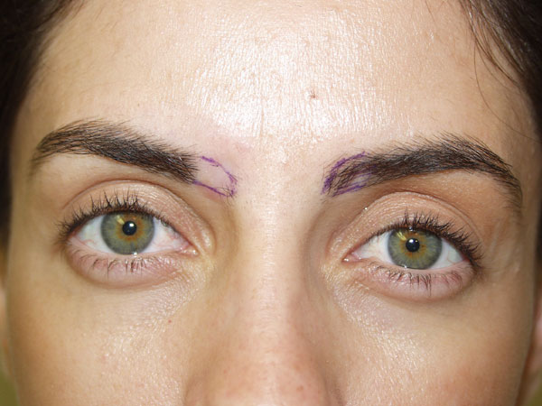 eyebrow transplant - patient 26 - before marked 1